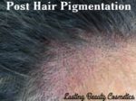 Post hair pigmentation