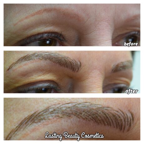 Tattoo Removal Eyebrows by Tammy