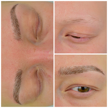 Alopecia Eyebrow solutions